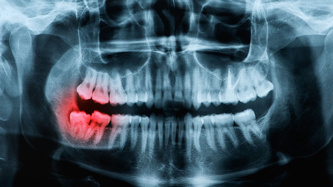 Bone Grafting