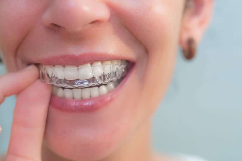 Can Invisalign Fix an Overbite? | Merrimac