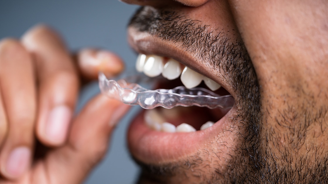 Clear Aligner