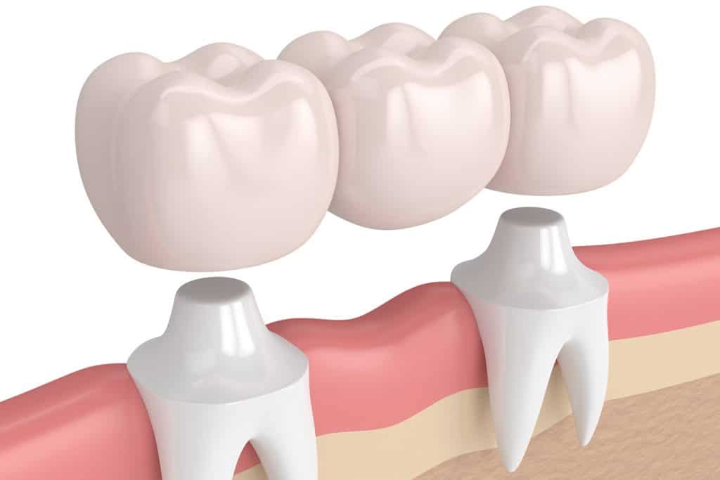 How Long Do Dental Bridges Last? | Merrimac