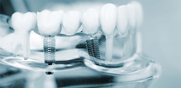 Dental Implants Image