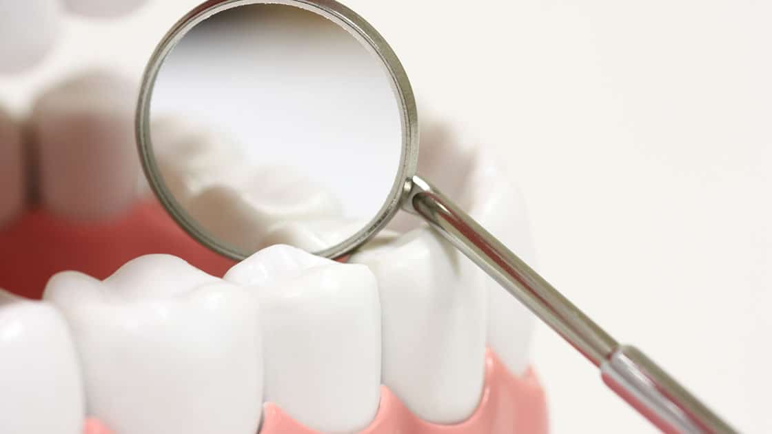 closeup of dental mirror and dental restoration