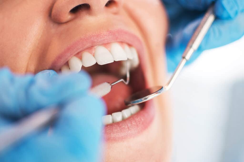 Teeth Whitening Options for Patients with Sensitive Teeth
