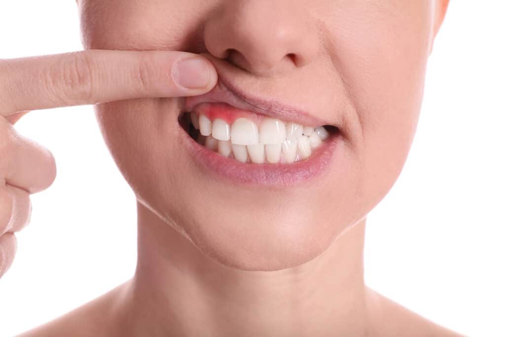 What Are the Different Stages of Gum Disease?