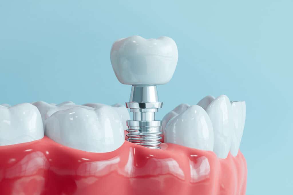 What's the Difference Between Mini Implants and Traditional Implants?